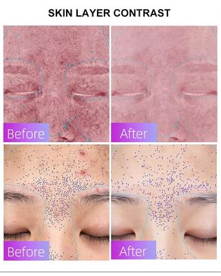 কেনা Blue Light Acne Treatment Mask with Intelligent Timer – Manufacturer Direct Supply, Appearance Patent Included অনলাইন উত্পাদন